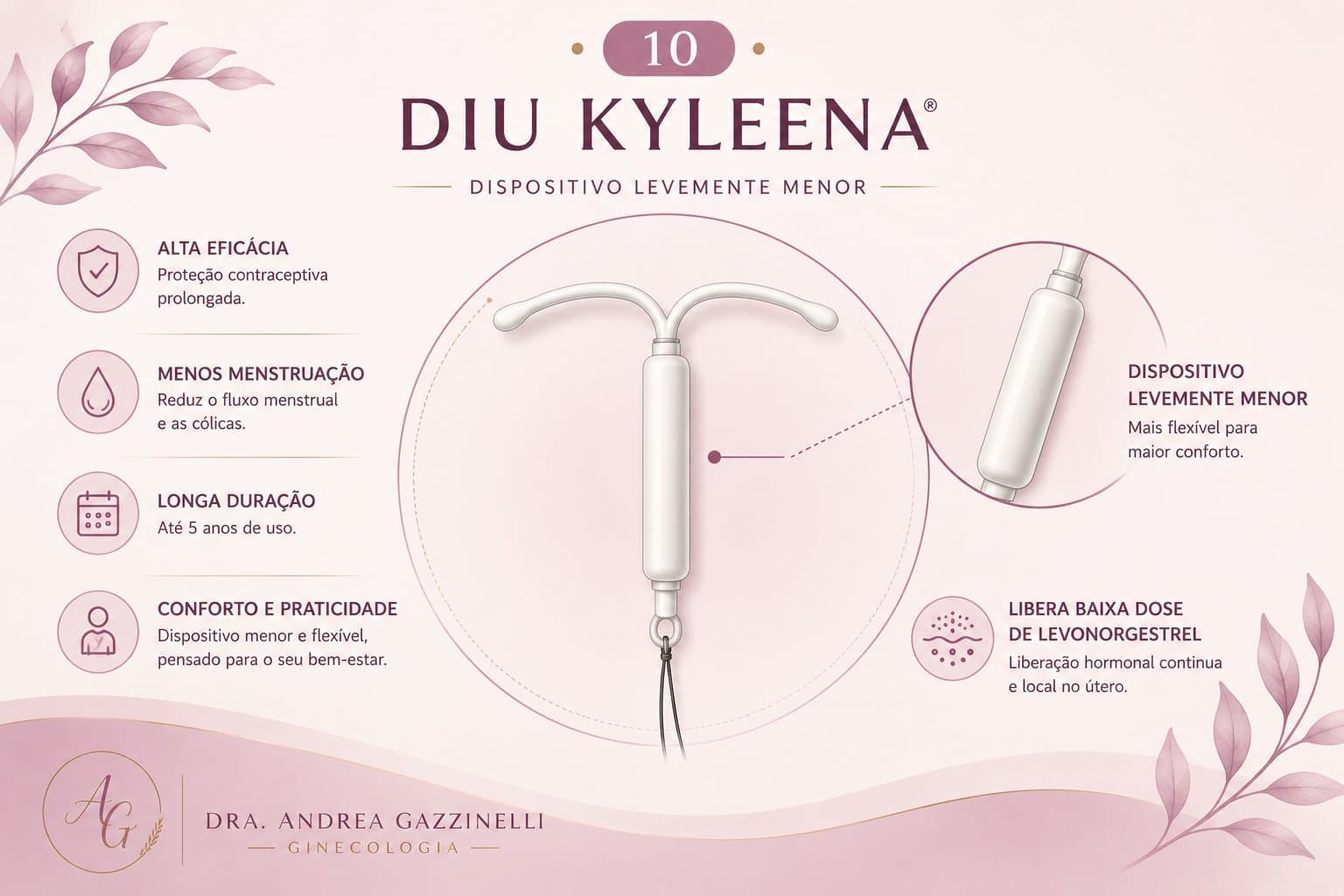 DIU Hormonal 19,5 mg (Kyleena®) — ilustração médica esquemática