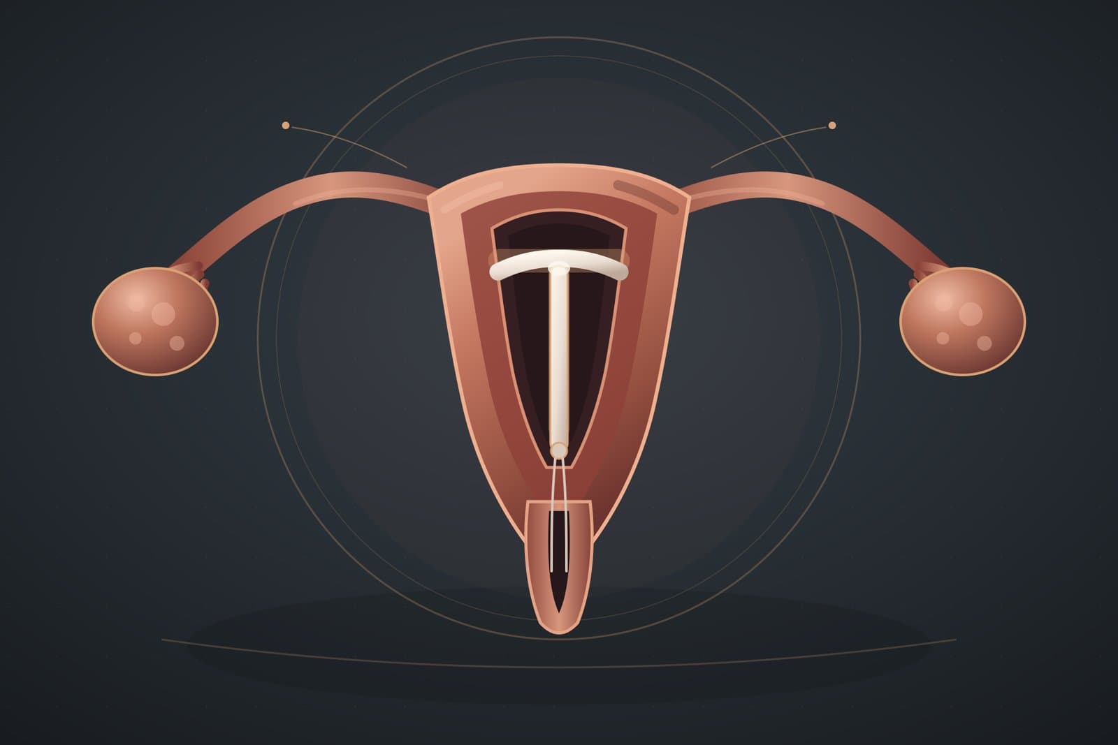 DIU (Dispositivo Intrauterino) — ilustração médica esquemática